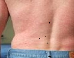 Posterior view of a patient’s back with a blotchy rash, captured in a clinical setting