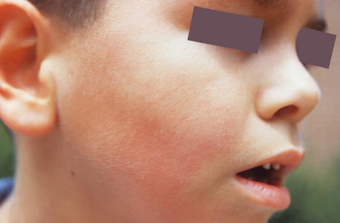 parvovirus B19 on child face