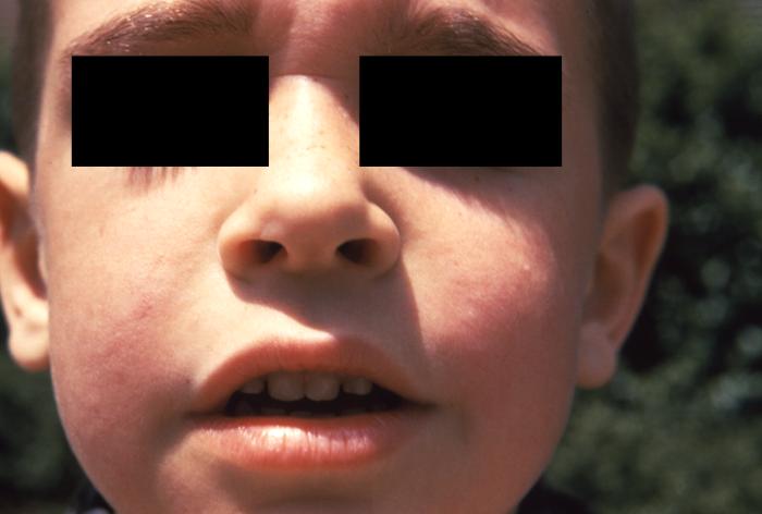parvovirus B19 on child face
