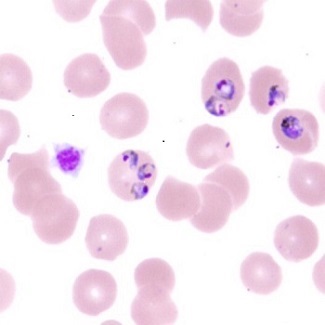 Malaria parasites, thick smear