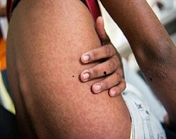 Chikungunya rash on arm