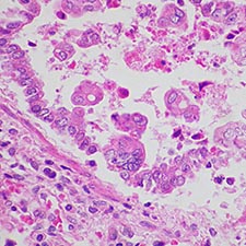 RSV Syncytial Virus. RSV Infection.