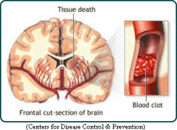 Image of brain and blood clot in vein